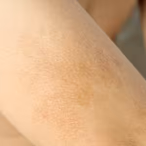 Jak na pigmentové skvrny