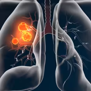 Profesorka Martina Koziar Vašáková: Rakovina plic často nebolí. Český screening ji ale umí odhalit včas