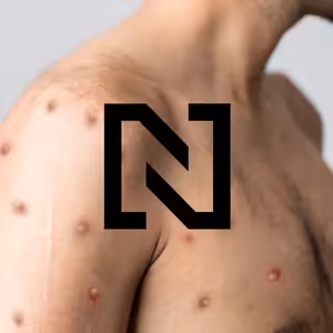 Co byste měli vědět o opičích neštovicích