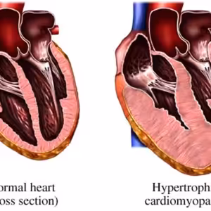 (KardioPodcast #2) Zabiják mladých sportovců - Hypertrofická KMP