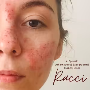 X. Epizoda - Jak se zbavuji jizev po akné - frakční laser