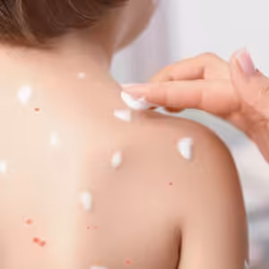 Neštovice u dětí - na co se připravit?