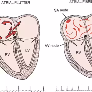 (KardioPodcast #9) Flutter versus Fibrilace